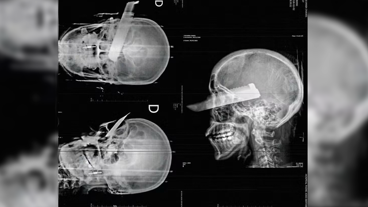 Mulher sobrevive a tentativa de feminicídio com faca cravada no olho em Santa Catarina