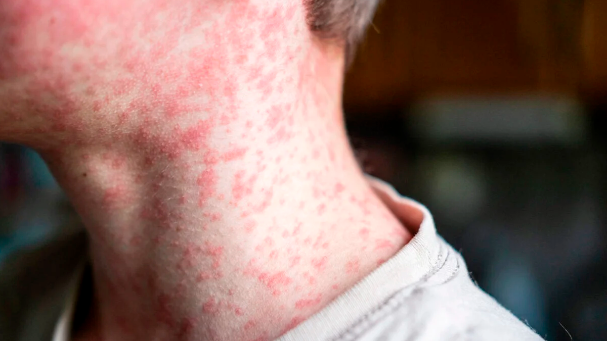 OMS emite alerta após explosão de casos de sarampo nas Américas