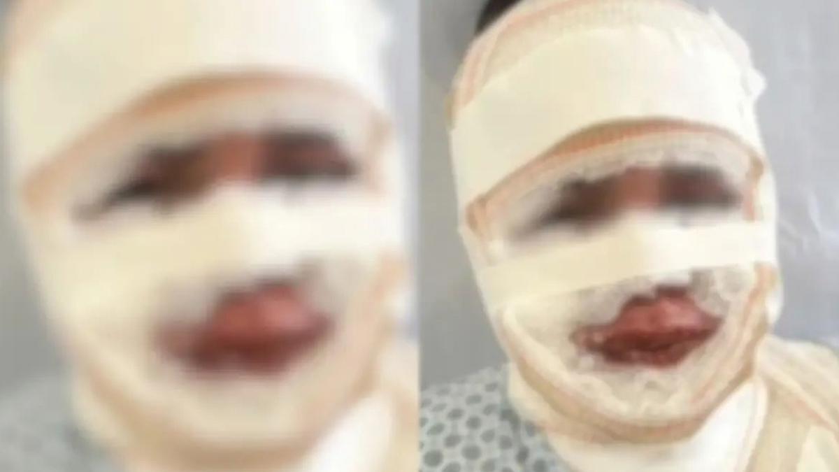 Fisioterapeuta é presa após jogar água fervente no rosto da atual namorada do ex